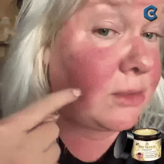 🐝 Paga 1 - Lleva 2🎁 ✨Bee Venom Treatment Cream 🐝